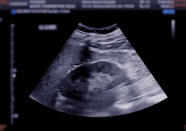Ultrasound upper abdomen showing  kidney. clipart