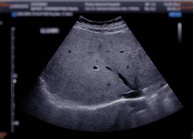 Ultrasound upper abdomen showing  liver. clipart