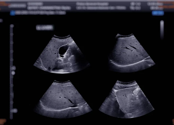 Ultrasonda Safra Kesesi Taşı Teşhisi Için Safra Kesesi Olduğu Görülüyor — Stok fotoğraf