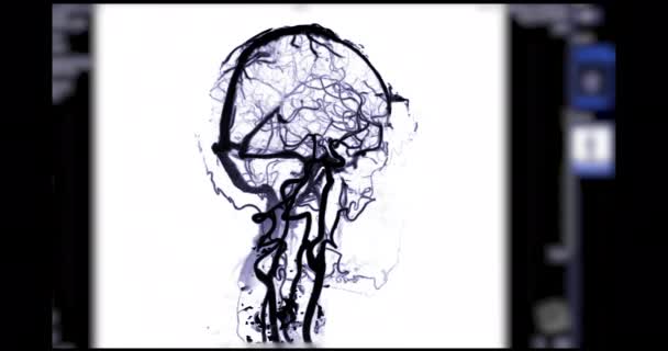 Ctv Exploración Cerebral Visualización Para Diagnóstico Trombosis Del Seno Venoso — Vídeos de Stock