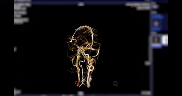 Ctv Сканирование Мозга Рендеринг Диагностики Тромбоза Венозной Пазухи — стоковое видео