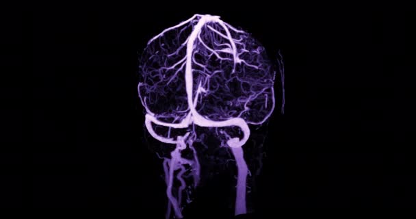 Ctv Brain Scan Rendering Zur Diagnose Venöser Sinusthrombosen — Stockvideo