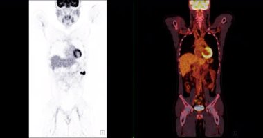  Tüm insan vücudunun pozitron emisyon tomografisi (PET CT) 3d görüntüleme kırmızı renk ton eksen görüntüsü ameliyattan sonra tümör yinelenmesi tespit etmek için.