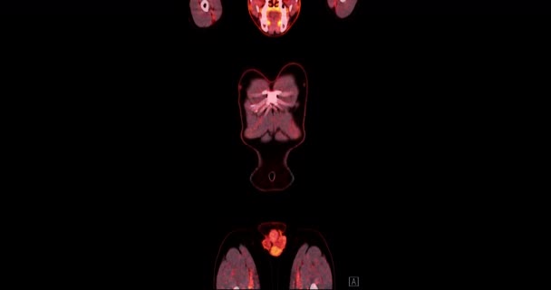 Pet Positron Emission Tomography ของร างกายมน างกาย แสดงภาพโทนส แดงม มมองแกนส — วีดีโอสต็อก
