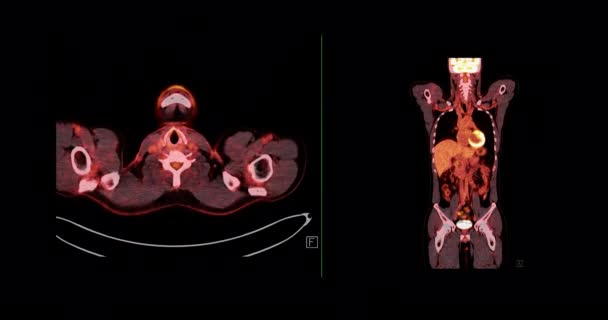 手術後の腫瘍再発を検出するための人体全体のPet 陽電子放出断層撮影 3Dレンダリング画像赤い色トーン軸方向ビュー — ストック動画
