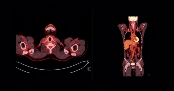 Pet Positron Emissziós Tomográfia Egész Emberi Test Renderelés Kép Piros — Stock videók