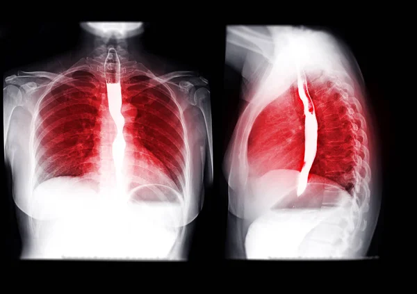 Collection Esophagram Barium Swallow Showing Esophagus Diagnosis Gerd Gastroesophageal Reflux — Stock Photo, Image