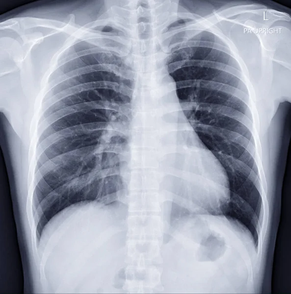 Chest Ray Image Diagnosis Tuberculosis Covid — Stock Photo, Image