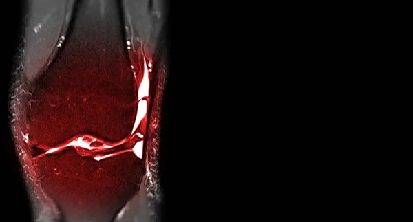 膝关节或Mri膝关节冠状透视磁共振成像检测前交叉韧带撕裂或扭伤 — 图库照片