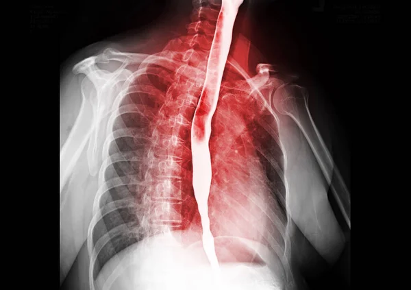 Esophagram Barium Swallow Showing Esophagus Diagnosis Gerd Gastroesophageal Reflux Disease — Stock Photo, Image