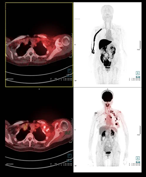 Pet手術後のがん再発を検出するための人体全体のスキャン画像 医療技術の概念 — ストック写真