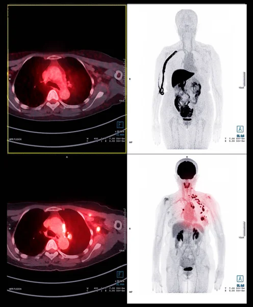 Pet手術後のがん再発を検出するための人体全体のスキャン画像 医療技術の概念 — ストック写真