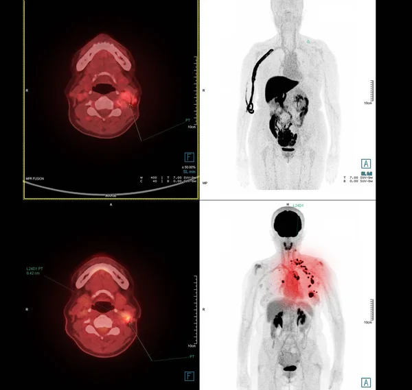 手術後の肺がんの再発を検出するための首のPetスキャン画像 医療技術の概念 — ストック写真