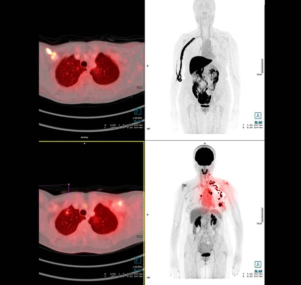 胸部または胸部のPetスキャン画像比較軸 手術後の肺がんの再発を検出するためのコロナ 医療技術の概念 — ストック写真