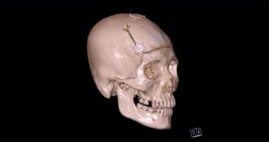 Tomografiden 3 boyutlu kafatası. Yüz kemiği taraması. 3 boyutlu. .