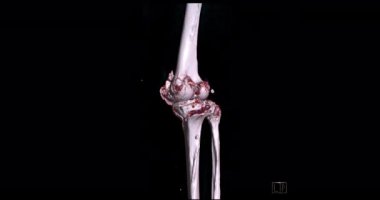 Diz tomografisinden 3 boyutlu diz tomografisi. 3D görüntüleme. Ekranda kırık kaval kemiği, incik kemiği ve kalça kemiği teşhisi için dön..