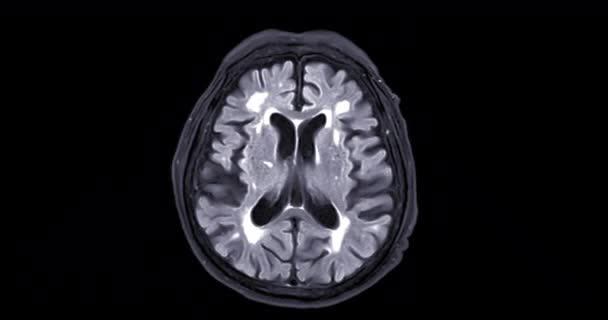 Mri Mózgu Lub Rezonansu Magnetycznego Mózgu Diagnozy Guza Mózgu Chorób — Wideo stockowe