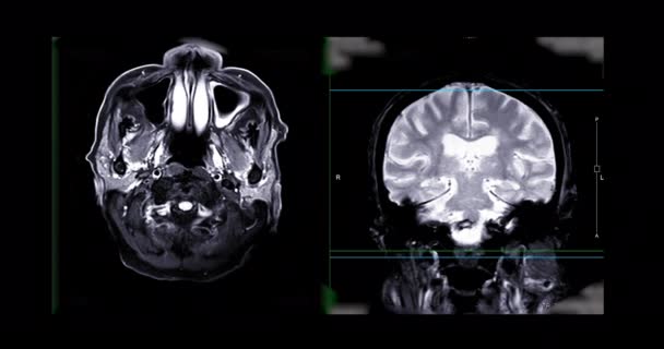 Kernspintomographie Des Gehirns Oder Magnetresonanztomographie Des Gehirns Zur Diagnose Von — Stockvideo