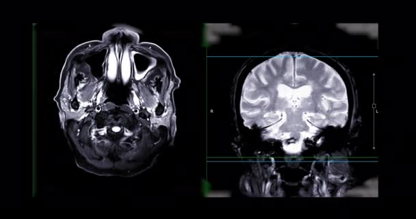 Cérebro Ressonância Magnética Cérebro Para Diagnóstico Tumores Cerebrais Doenças Avc — Vídeo de Stock