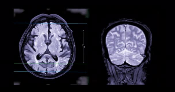 脳腫瘍や脳卒中の診断のための脳の脳や磁気共鳴画像法のMri — ストック動画