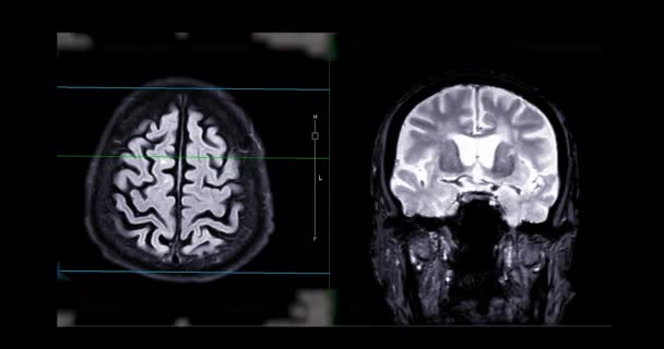 Del Cervello Risonanza Magnetica Del Cervello Diagnosi Tumore Cervello Malattie — Video Stock