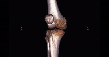 Diz tomografisinden 3 boyutlu diz tomografisi. 3D görüntüleme. Ekranda kırık kaval kemiği, incik kemiği ve kalça kemiği teşhisi için dön..