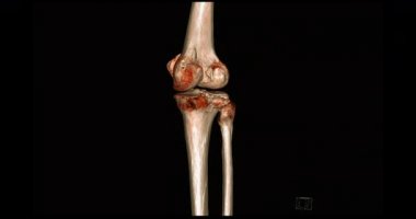 Diz tomografisinden 3 boyutlu diz tomografisi. 3D görüntüleme. Ekranda kırık kaval kemiği, incik kemiği ve kalça kemiği teşhisi için dön..