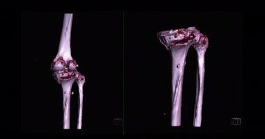 Diz tomografisinden 3 boyutlu diz tomografisi. 3D görüntüleme. Ekranda kırık kaval kemiği, incik kemiği ve kalça kemiği teşhisi için dön..