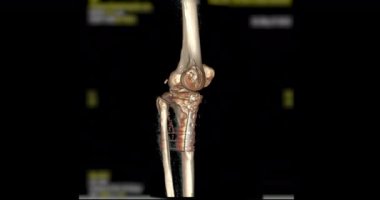 Diz tomografisinden 3 boyutlu diz tomografisi. 3D görüntüleme. Ekranda kırık kaval kemiği, incik kemiği ve kalça kemiği teşhisi için dön..