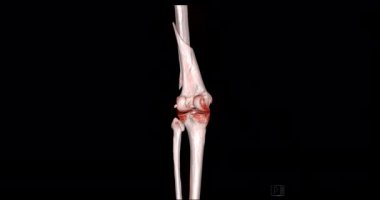 Diz tomografisinden 3 boyutlu diz tomografisi. 3D görüntüleme. Ekranda kırık kaval kemiği, incik kemiği ve kalça kemiği teşhisi için dön..