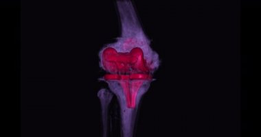 Diz tomografisinden 3 boyutlu diz tomografisi. 3D görüntüleme. Ekranda kırık kaval kemiği, incik kemiği ve kalça kemiği teşhisi için dön..