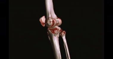 Diz tomografisinden 3 boyutlu diz tomografisi. 3D görüntüleme. Ekranda kırık kaval kemiği, incik kemiği ve kalça kemiği teşhisi için dön..