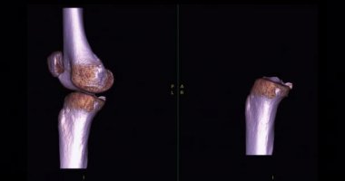 Diz tomografisinden 3 boyutlu diz tomografisi. 3D görüntüleme. Ekranda kırık kaval kemiği, incik kemiği ve kalça kemiği teşhisi için dön..