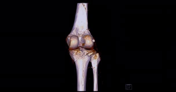 Ctから膝3D関節3Dレンダリング画像診断骨折Tibia Fibulaと大腿骨の骨のための画面上で好転します — ストック動画