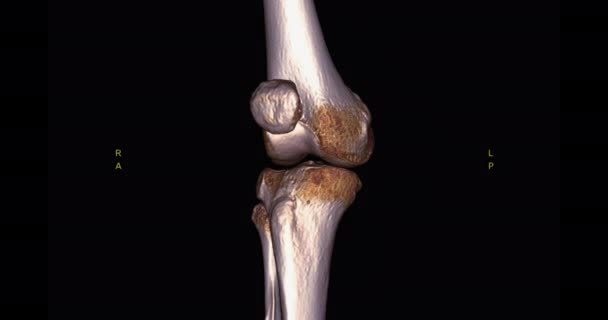 膝关节Ct扫描的膝关节3D图像在屏幕上回转诊断胫骨 腓骨和股骨骨折 — 图库视频影像