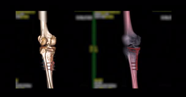 Ginocchio Scansione Dell Articolazione Del Ginocchio Immagine Rendering Capovolta Sullo — Video Stock