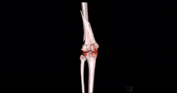 Knee Сканування Суглоба Коліном Рендеринг Зображення Розвертається Екрані Діагностики Переломів — стокове відео