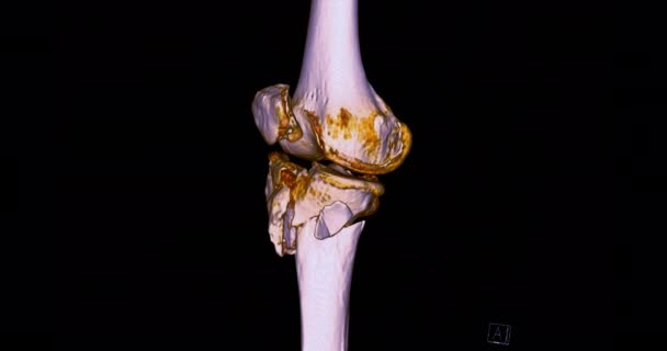 렌더링 이미지 스캔에서 대퇴골의 진단을 화면을 돌려볼 수있는 관절의 — 비디오