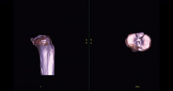 Ctから膝3D関節3Dレンダリング画像診断骨折Tibia Fibulaと大腿骨の骨のための画面上で好転します — ストック動画