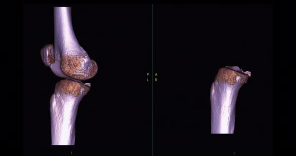 Ctから膝3D関節3Dレンダリング画像診断骨折Tibia Fibulaと大腿骨の骨のための画面上で好転します — ストック動画