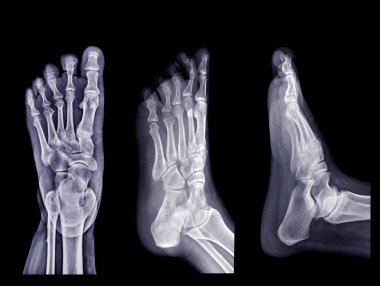Ayak x-ray resmi koleksiyonu siyah arkaplanda izole edildi.