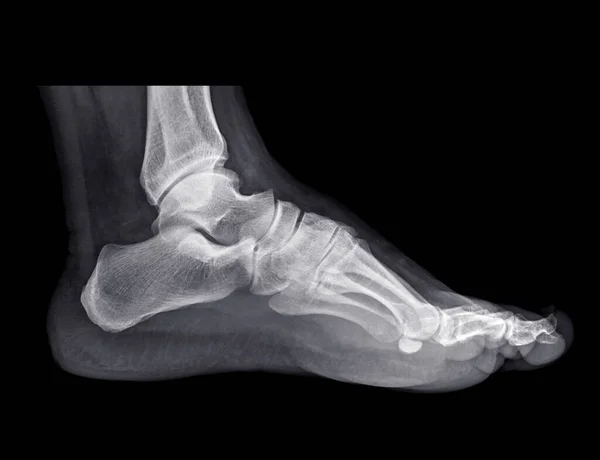 黒い背景に隔離された足のX線画像 — ストック写真