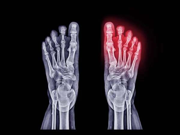Both Foot x-ray image  isolated on black background.