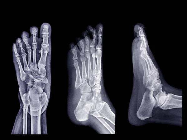 Sammlung Von Fuß Röntgenbild Isoliert Auf Schwarzem Hintergrund — Stockfoto