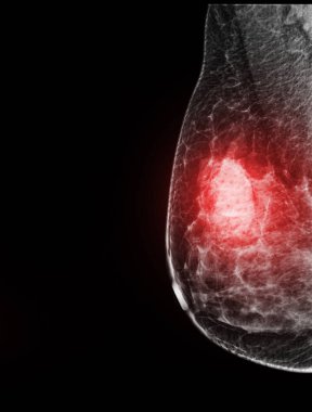  X-ray Digital Mammogram  or mammography  of the breast  CC view  for diagnonsis Breast cancer in women isolated on black background.