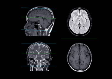 MRI  brain compare axial, coronal and sagittal plane  for detect stroke disease and Brain tumors and cysts.