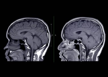 MRI beyin sagittal t1w non gadolium ve inme hastalıklarını tespit etmek için gadolinyum ile beyin tümörlerini ve kistleri karşılaştırır..