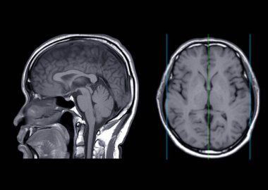 MRI  brain  axial T1W  plane  sagittal and axial view for detect stroke disease and Brain tumors and cysts.