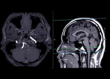 Beyin eksensel MIP 'nin MRA Beyin veya Manyetik rezonans anjiyografisi ve serebral arteri gösteren sagittal görüş .