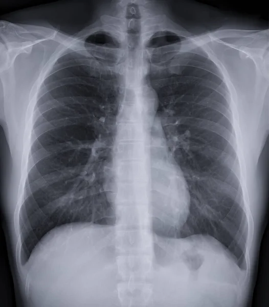 Chest Ray Image Screening Diagnosis Tuberculosis Covid — Φωτογραφία Αρχείου